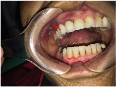 Osimertinib: Another medication related to osteonecrosis of the jaws? A case report and literature review